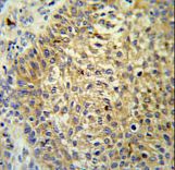 TMEM222 Antibody - TM222 Antibody IHC of formalin-fixed and paraffin-embedded bladder carcinoma followed by peroxidase-conjugated secondary antibody and DAB staining.