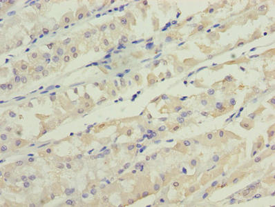 TMEM31 Antibody - Immunohistochemistry of paraffin-embedded human gastric cancer using TMEM31 Antibody at dilution of 1:100