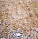 TMEM43 Antibody - TMEM43 Antibody immunohistochemistry of formalin-fixed and paraffin-embedded human esophageal carcinoma followed by peroxidase-conjugated secondary antibody and DAB staining.