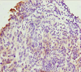 TMEM43 Antibody - Immunohistochemistry of paraffin-embedded human bladder cancer at dilution 1:100