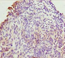 TMEM43 Antibody - Immunohistochemistry of paraffin-embedded human bladder cancer at dilution 1:100