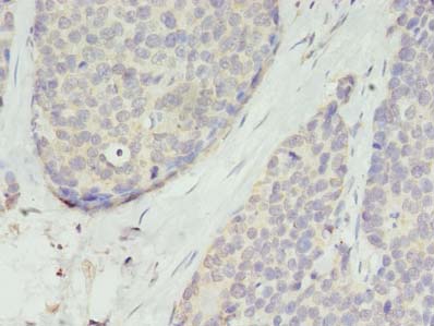 TMEM45A Antibody - Immunohistochemistry of paraffin-embedded human gastric cancer using antibody at dilution of 1:100.