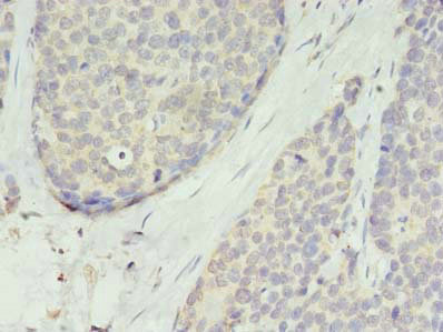 TMEM45A Antibody - Immunohistochemistry of paraffin-embedded human gastric cancer using TMEM45A Antibody at dilution of 1:100