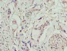 TMEM53 Antibody - Immunohistochemistry of paraffin-embedded human pancreatic cancer using antibody at dilution of 1:100.