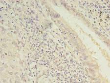 TMEM55A Antibody - Immunohistochemistry of paraffin-embedded human lung cancer using antibody at dilution of 1:100.