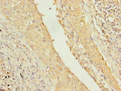 TMEM55A Antibody - Immunohistochemistry of paraffin-embedded human lung cancer using TMEM55A Antibody at dilution of 1:100