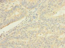 TMEM56 Antibody - Immunohistochemistry of paraffin-embedded human endometrial cancer using TMEM56 Antibody at dilution of 1:100