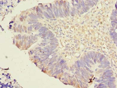 TMEM59L Antibody - Immunohistochemistry of paraffin-embedded human ovarian cancer using antibody at dilution of 1:100.