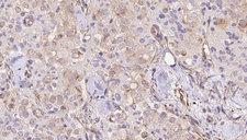 TMEM70 Antibody - 1:100 staining human thyroid carcinoma tissue by IHC-P. The sample was formaldehyde fixed and a heat mediated antigen retrieval step in citrate buffer was performed. The sample was then blocked and incubated with the antibody for 1.5 hours at 22°C. An HRP conjugated goat anti-rabbit antibody was used as the secondary.