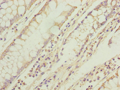 TMEM71 Antibody - Immunohistochemistry of paraffin-embedded human colon cancer using TMEM71 Antibody at dilution of 1:100