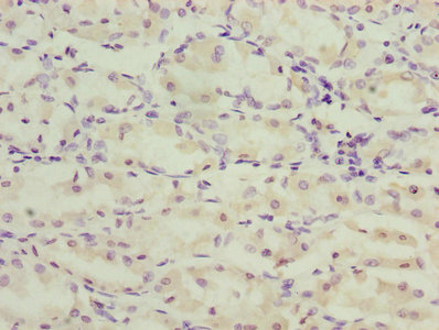TMEM71 Antibody - Immunohistochemistry of paraffin-embedded human gastric cancer using TMEM71 Antibody at dilution of 1:100