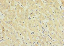 TMEM91 Antibody - Immunohistochemistry of paraffin-embedded human liver cancer using TMEM91 Antibody at dilution of 1:100
