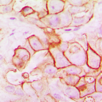 TMEPAI / PMEPA1 Antibody - Immunohistochemical analysis of PMEPA1 staining in human breast cancer formalin fixed paraffin embedded tissue section. The section was pre-treated using heat mediated antigen retrieval with sodium citrate buffer (pH 6.0). The section was then incubated with the antibody at room temperature and detected using an HRP conjugated compact polymer system. DAB was used as the chromogen. The section was then counterstained with hematoxylin and mounted with DPX.