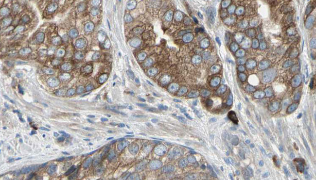 TMEPAI / PMEPA1 Antibody - 1:100 staining human prostate tissue by IHC-P. The sample was formaldehyde fixed and a heat mediated antigen retrieval step in citrate buffer was performed. The sample was then blocked and incubated with the antibody for 1.5 hours at 22°C. An HRP conjugated goat anti-rabbit antibody was used as the secondary.