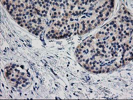 TMOD1 / Tropomodulin 1 Antibody - IHC of paraffin-embedded Carcinoma of Human pancreas tissue using anti-TMOD1 mouse monoclonal antibody. (Heat-induced epitope retrieval by 10mM citric buffer, pH6.0, 100C for 10min).