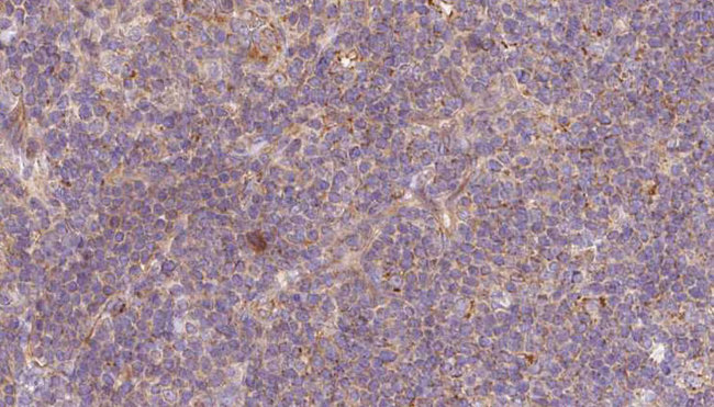 TMOD1 / Tropomodulin 1 Antibody - 1:100 staining human lymph carcinoma tissue by IHC-P. The sample was formaldehyde fixed and a heat mediated antigen retrieval step in citrate buffer was performed. The sample was then blocked and incubated with the antibody for 1.5 hours at 22°C. An HRP conjugated goat anti-rabbit antibody was used as the secondary.