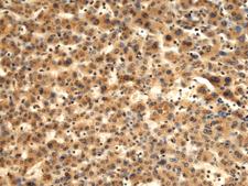 TMOD1 / Tropomodulin 1 Antibody - Immunohistochemistry of paraffin-embedded Human liver cancer tissue  using TMOD1 Polyclonal Antibody at dilution of 1:60(×200)