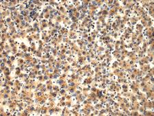 TMOD1 / Tropomodulin 1 Antibody - Immunohistochemistry of paraffin-embedded Human liver cancer tissue  using TMOD1 Polyclonal Antibody at dilution of 1:65(×200)