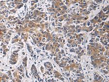 TMOD3 / Tropomodulin 3 Antibody - Immunohistochemistry of paraffin-embedded Human colorectal cancer tissue  using TMOD3 Polyclonal Antibody at dilution of 1:60(×200)