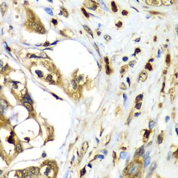 TMOD4 Antibody - Immunohistochemistry of paraffin-embedded human liver cancer tissue.