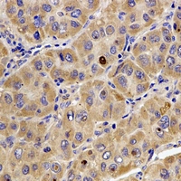 TMOD4 Antibody - Immunohistochemical analysis of Tropomodulin-4 staining in human liver cancer formalin fixed paraffin embedded tissue section. The section was pre-treated using heat mediated antigen retrieval with sodium citrate buffer (pH 6.0). The section was then incubated with the antibody at room temperature and detected using an HRP conjugated compact polymer system. DAB was used as the chromogen. The section was then counterstained with hematoxylin and mounted with DPX.