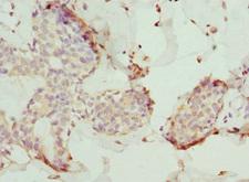TMOD4 Antibody - Immunohistochemistry of paraffin-embedded human breast cancer at dilution 1:100