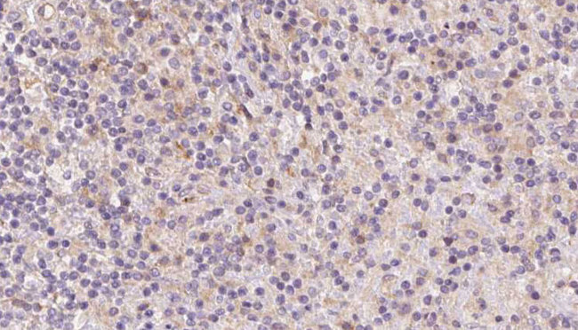 TMOD4 Antibody - 1:100 staining human lymph carcinoma tissue by IHC-P. The sample was formaldehyde fixed and a heat mediated antigen retrieval step in citrate buffer was performed. The sample was then blocked and incubated with the antibody for 1.5 hours at 22°C. An HRP conjugated goat anti-rabbit antibody was used as the secondary.