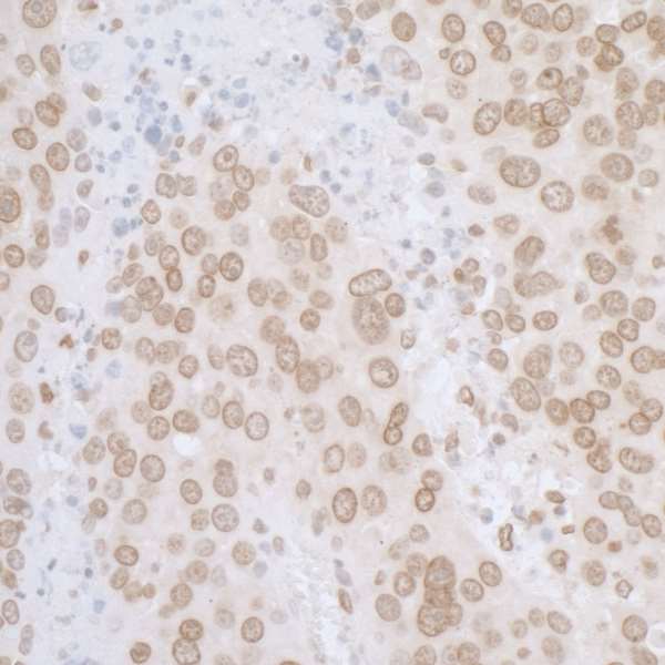 TMPO / TP / Thymopoietin Antibody - Detection of mouse LAP2 alpha beta gamma/TMPO by immunohistochemistry. Sample: FFPE section of mouse plasmacytoma. Antibody: Affinity purified rabbit anti-L AP2 alpha beta gamma/TMPO used at a dilution of 1:5,000 (0.2µg/ml). Detection: DAB