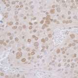 TMPO / TP / Thymopoietin Antibody - Detection of mouse LAP2 alpha/TMPO by immunohistochemistry. Sample: FFPE section of mouse renal cell carcinoma. Antibody: Affinity purified rabbit anti-L AP2 alpha/TMPO used at a dilution of 1:1,000 (1µg/ml). Detection: DAB