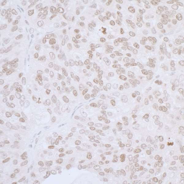 TMPO / TP / Thymopoietin Antibody - Detection of human LAP2 alpha/TMPO by immunohistochemistry. Sample: FFPE section of human breast carcinoma. Antibody: Affinity purified rabbit anti-L AP2 alpha/TMPO used at a dilution of 1:5,000 (0.2µg/ml). Detection: DAB