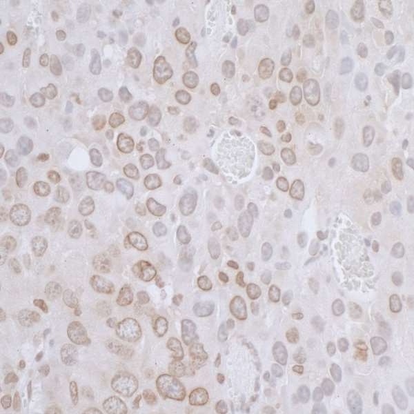 TMPO / TP / Thymopoietin Antibody - Detection of mouse LAP2 beta/TMPO by immunohistochemistry. Sample: FFPE section of mouse renal cell carcinoma. Antibody: Affinity purified rabbit anti-L AP2 beta /TMPO used at a dilution of 1:1,000 (1µg/ml). Detection: DAB