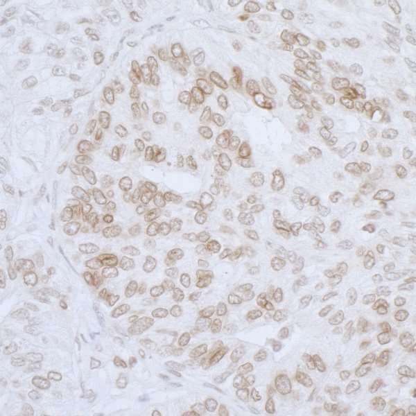 TMPO / TP / Thymopoietin Antibody - Detection of human LAP2 beta/TMPO by immunohistochemistry. Sample: FFPE section of human ovarian carcinoma. Antibody: Affinity purified rabbit anti-L AP2 beta /TMPO used at a dilution of 1:1,000 (1µg/ml). Detection: DAB