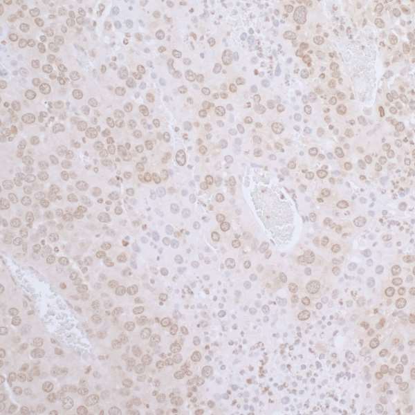 TMPO / TP / Thymopoietin Antibody - Detection of mouse LAP2 beta gamma /TMPO by immunohistochemistry. Sample: FFPE section of mouse renal cell carcinoma. Antibody: Affinity purified rabbit anti-L AP2 beta gamma/TMPO used at a dilution of 1:1,000 (1µg/ml). Detection: DAB