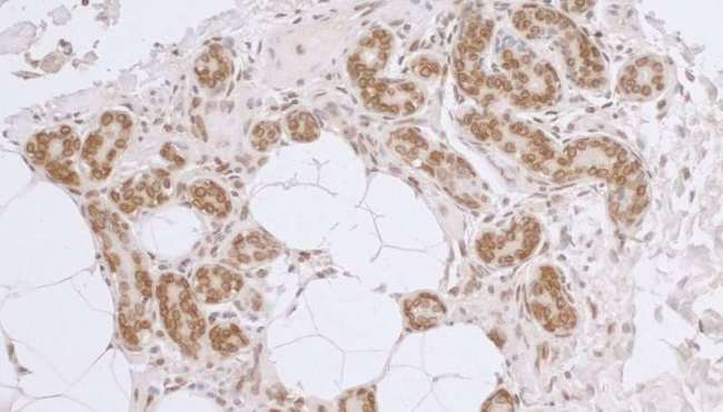 TMPO / TP / Thymopoietin Antibody - Detection of human LAP2 beta gamma /TMPO by immunohistochemistry. Sample: FFPE section of human breast carcinoma. Antibody: Affinity purified rabbit anti-L AP2 beta gamma/TMPO used at a dilution of 1:5,000 (0.2µg/ml). Detection: DAB