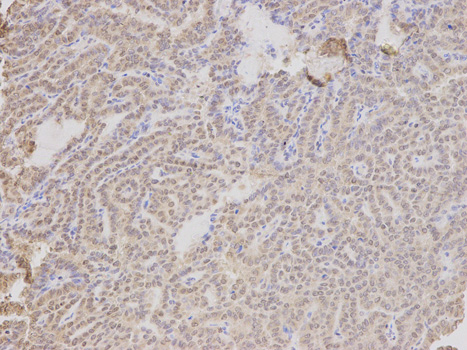 TMPO / TP / Thymopoietin Antibody - Immunohistochemistry of paraffin-embedded human breast cancer using TMPO antibody at dilution of 1:200 (400x lens).