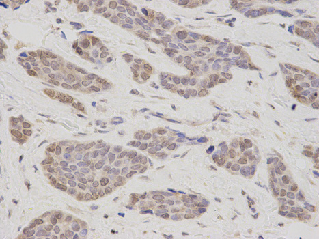 TMPO / TP / Thymopoietin Antibody - Immunohistochemistry of paraffin-embedded human endometrial cancer using TMPO antibody at dilution of 1:200 (400x lens)