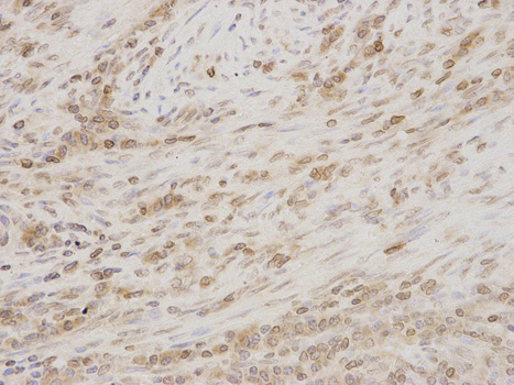 TMPO / TP / Thymopoietin Antibody - Immunohistochemistry of paraffin-embedded human thyroid cancer using TMPO antibody at dilution of 1:200 (200x lens).