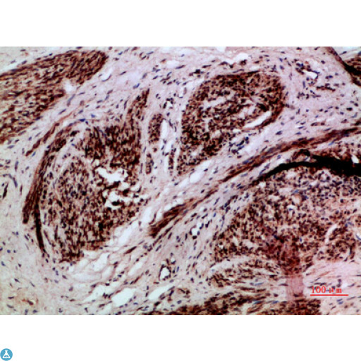 TMPO / TP / Thymopoietin Antibody - Immunohistochemical analysis of paraffin-embedded human-cervical-cancer, antibody was diluted at 1:200.