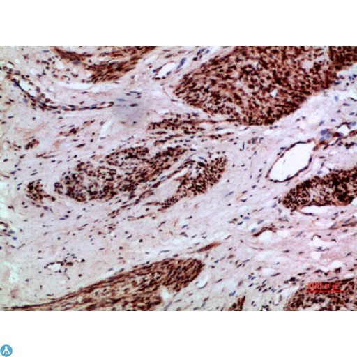 TMPO / TP / Thymopoietin Antibody - Immunohistochemical analysis of paraffin-embedded human-cervical-cancer, antibody was diluted at 1:200.