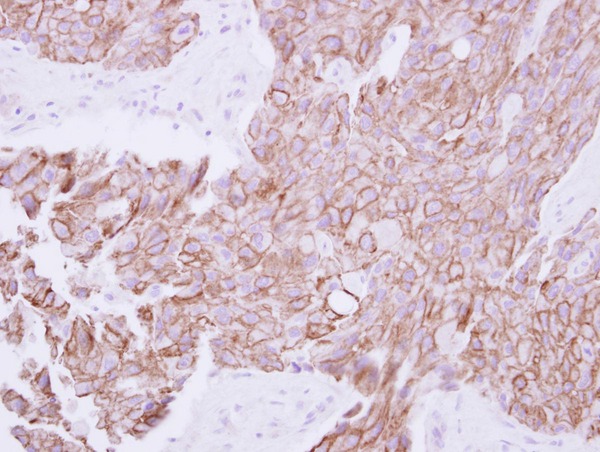 TMPRSS11B Antibody - IHC of paraffin-embedded Breast ca, using TMPRSS11B antibody at 1:250 dilution.