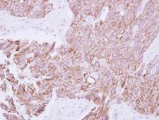 TMPRSS11B Antibody - IHC of paraffin-embedded Breast ca, using TMPRSS11B antibody at 1:250 dilution.
