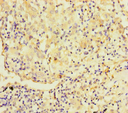 TMPRSS11B Antibody - Immunohistochemistry of paraffin-embedded human lung cancer using TMPRSS11B Antibody at dilution of 1:100