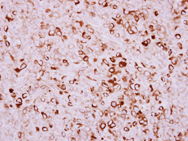 TMPRSS11D / HAT Antibody - IHC of paraffin-embedded Breast ca, using TMPRSS11D antibody at 1:250 dilution.
