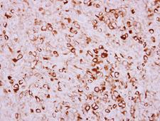TMPRSS11D / HAT Antibody - IHC of paraffin-embedded Breast ca, using TMPRSS11D antibody at 1:250 dilution.