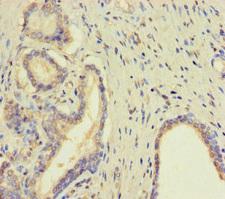 TMPRSS11D / HAT Antibody - Immunohistochemistry of paraffin-embedded human prostate cancer using TMPRSS11D Antibody at dilution of 1:100