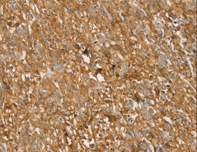 TMPRSS11F Antibody - Immunohistochemistry of paraffin-embedded Human gastric cancer using TMPRSS11F Polyclonal Antibody at dilution of 1:30.