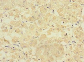 TMPRSS15 / Enterokinase Antibody - Immunohistochemistry of paraffin-embedded human gastric cancer at dilution 1:100