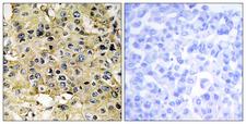 TMPRSS15 / Enterokinase Antibody - Peptide - + Immunohistochemistry analysis of paraffin-embedded human breast carcinoma tissue, using ENTK antibody.