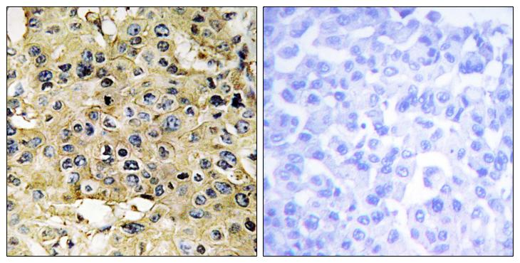 TMPRSS15 / Enterokinase Antibody - Peptide - + Immunohistochemistry analysis of paraffin-embedded human breast carcinoma tissue, using ENTK antibody.