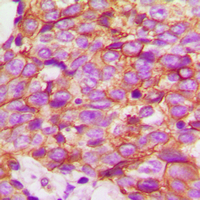 TMPRSS3 Antibody - Immunohistochemical analysis of ECHOS1 staining in human breast cancer formalin fixed paraffin embedded tissue section. The section was pre-treated using heat mediated antigen retrieval with sodium citrate buffer (pH 6.0). The section was then incubated with the antibody at room temperature and detected using an HRP-conjugated compact polymer system. DAB was used as the chromogen. The section was then counterstained with hematoxylin and mounted with DPX.